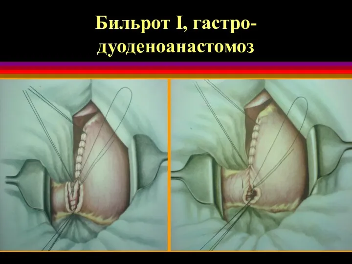 Бильрот I, гастро-дуоденоанастомоз