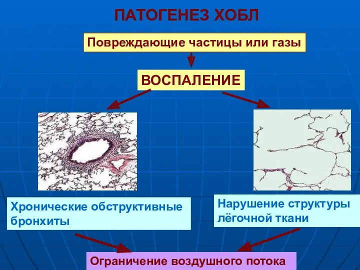 Повреждающие частицы или газы ПАТОГЕНЕЗ ХОБЛ ВОСПАЛЕНИЕ Хронические обструктивные бронхиты