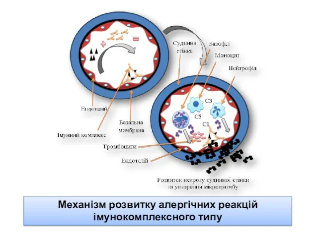 Механізм розвитку алергічних реакцій імунокомплексного типу