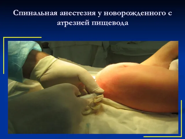 Спинальная анестезия у новорожденного с атрезией пищевода