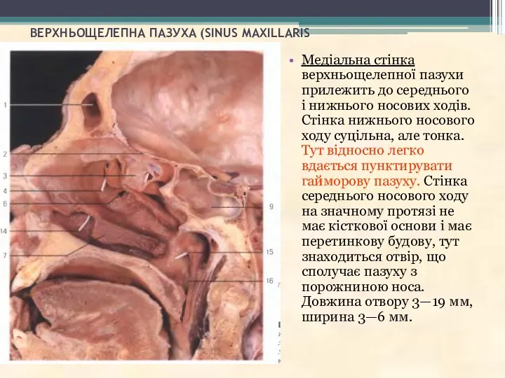 ВЕРХНЬОЩЕЛЕПНА ПАЗУХА (SINUS MAXILLARIS Медіальна стінка верхньощелепної пазухи прилежить до