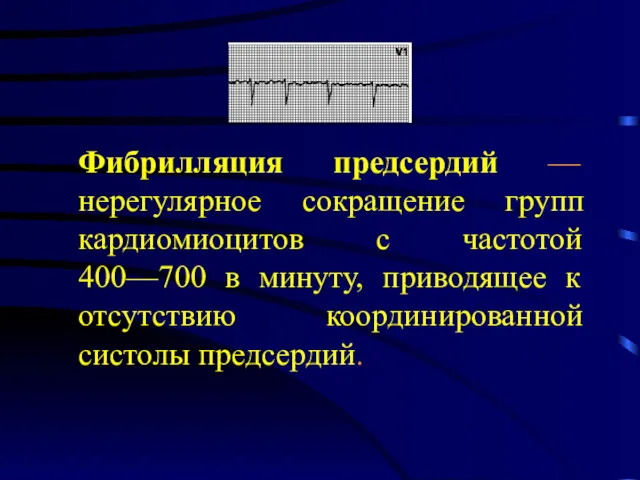 Фибрилляция предсердий — нерегулярное сокращение групп кардиомиоцитов с частотой 400—700