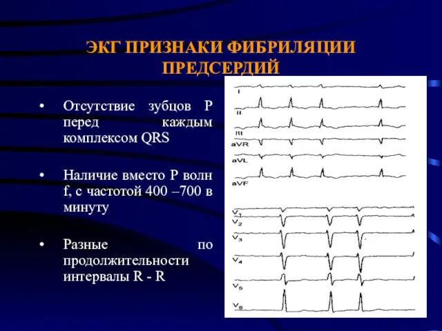 ЭКГ ПРИЗНАКИ ФИБРИЛЯЦИИ ПРЕДСЕРДИЙ Отсутствие зубцов P перед каждым комплексом