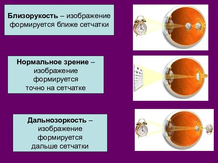 Близорукость – изображение формируется ближе сетчатки Нормальное зрение – изображение формируется точно на
