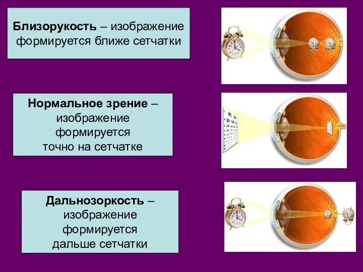 Близорукость – изображение формируется ближе сетчатки Нормальное зрение – изображение