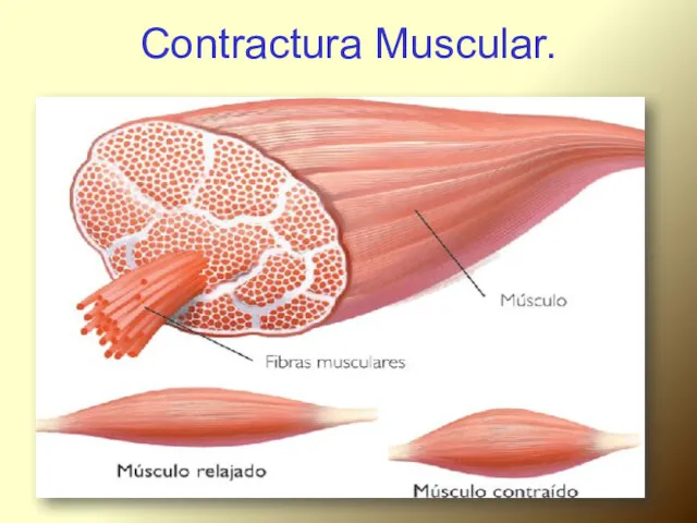 Contractura Muscular.