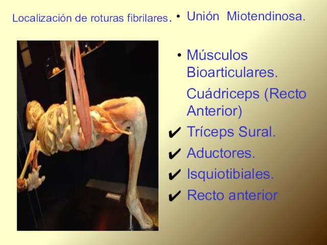 Localización de roturas fibrilares. Unión Miotendinosa. Músculos Bioarticulares. Cuádriceps (Recto