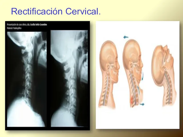 Rectificación Cervical.