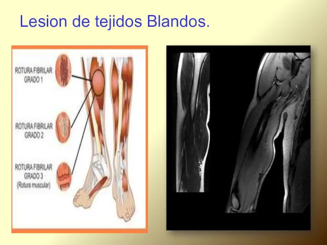 Lesion de tejidos Blandos.