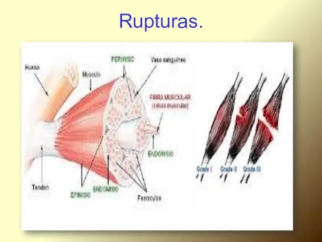 Rupturas.