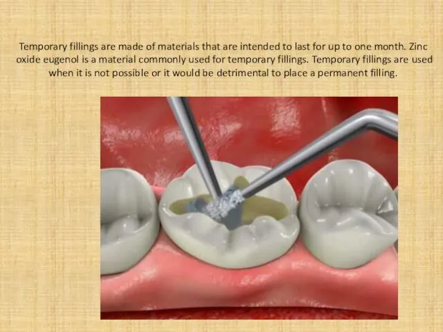 Temporary fillings are made of materials that are intended to