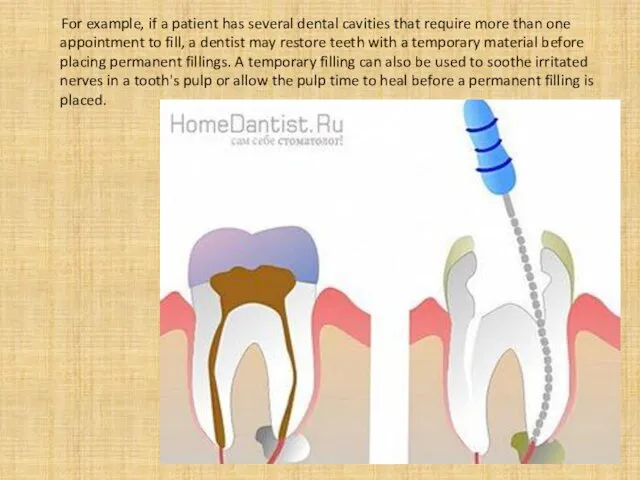 For example, if a patient has several dental cavities that