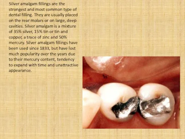 Silver amalgam fillings are the strongest and most common type