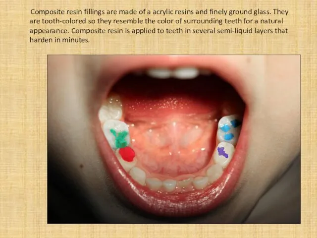 Composite resin fillings are made of a acrylic resins and