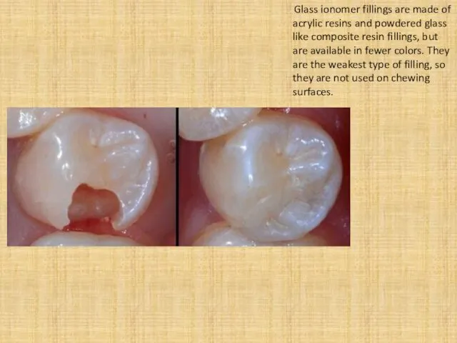 Glass ionomer fillings are made of acrylic resins and powdered