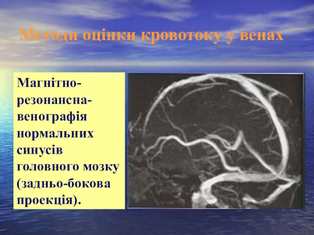 Методи оцінки кровотоку у венах Магнітно-резонансна-венографія нормальних синусів головного мозку (задньо-бокова проекція).