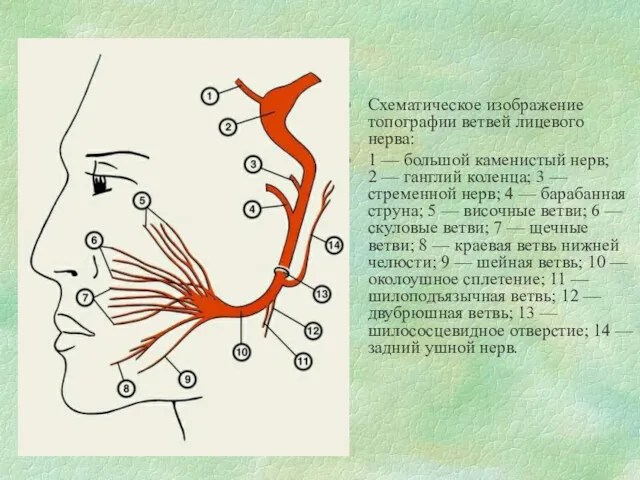 Схематическое изображение топографии ветвей лицевого нерва: 1 — большой каменистый нерв; 2 —