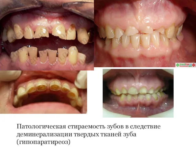 Патологическая стираемость зубов в следствие деминерализации твердых тканей зуба (гипопаратиреоз)