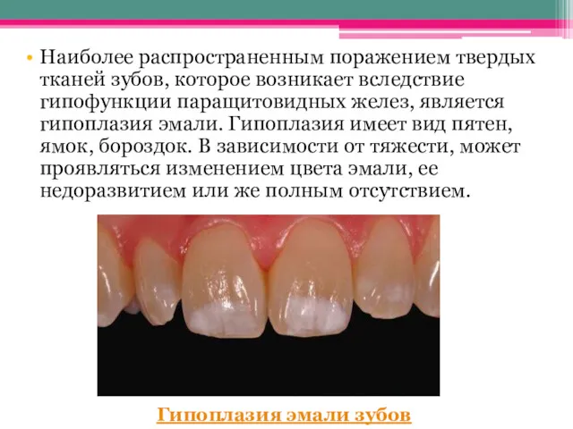 Наиболее распространенным поражением твердых тканей зубов, которое возникает вследствие гипофункции