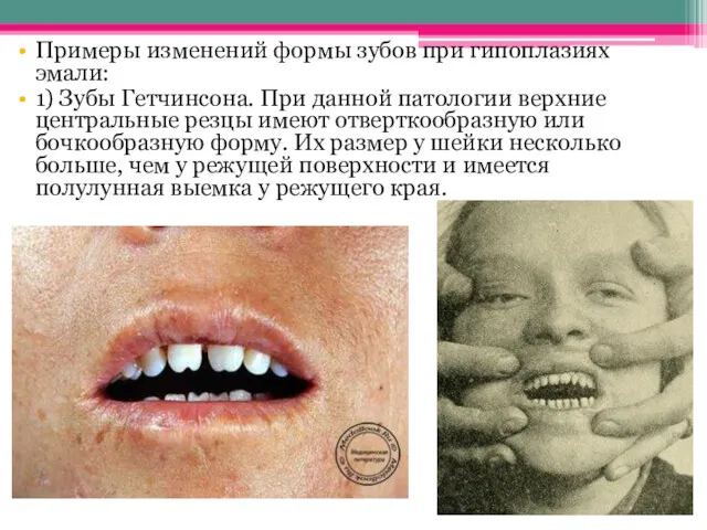 Примеры изменений формы зубов при гипоплазиях эмали: 1) Зубы Гетчинсона.