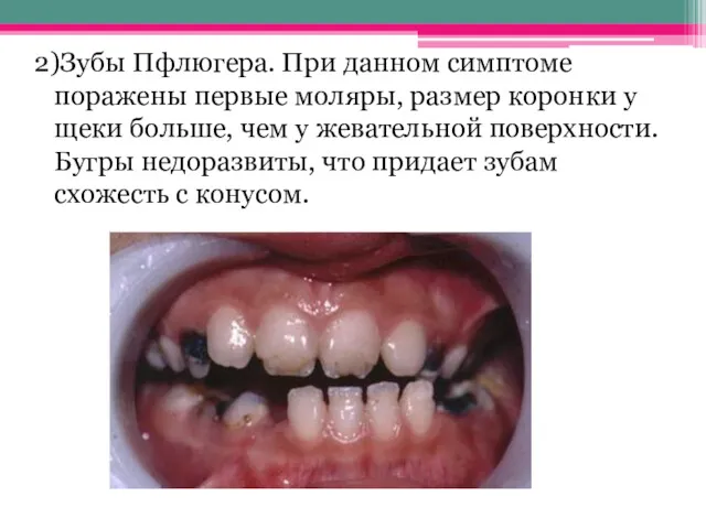 2)Зубы Пфлюгера. При данном симптоме поражены первые моляры, размер коронки
