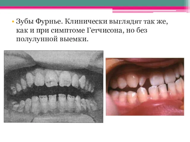 Зубы Фурнье. Клинически выглядят так же, как и при симптоме Гетчисона, но без полулунной выемки.