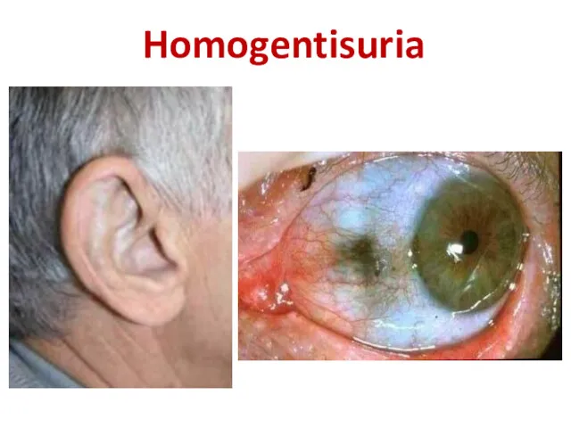 Homogentisuria