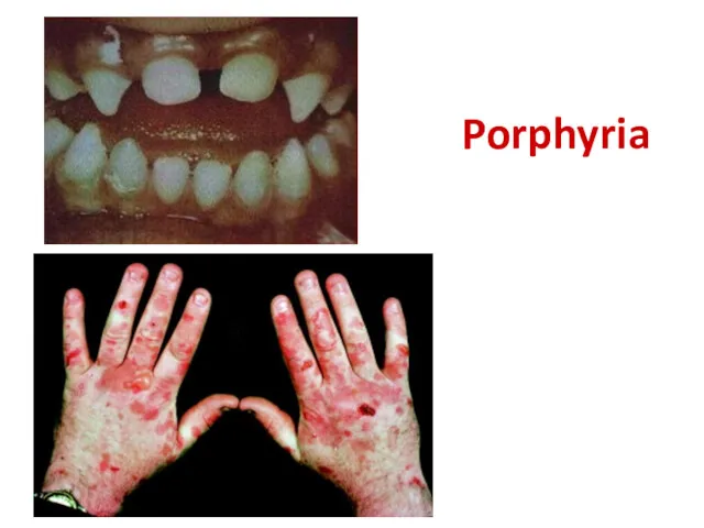 Porphyria