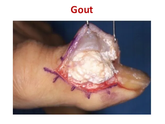 Gout