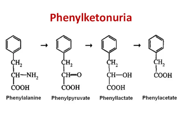 Phenylketonuria