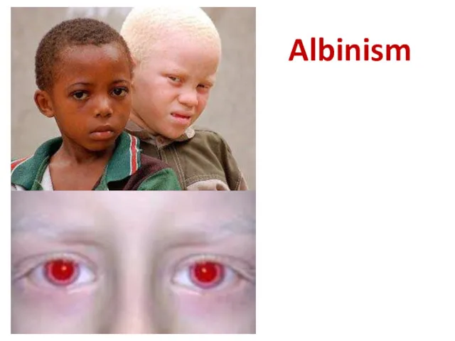 Albinism