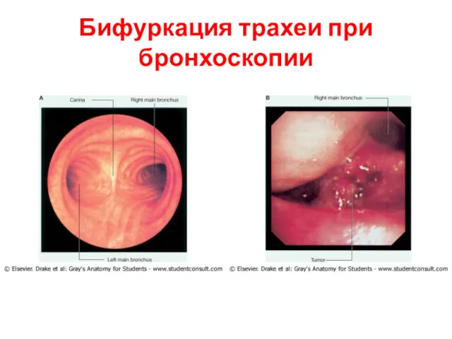 Бифуркация трахеи при бронхоскопии
