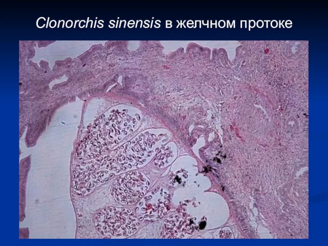 Clonorchis sinensis в желчном протоке