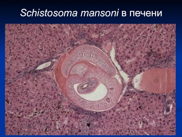 Schistosoma mansoni в печени