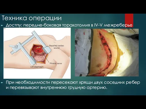 Техника операции Достпу: передне-боковая торакотомия в IV-V межреберье При необходимости