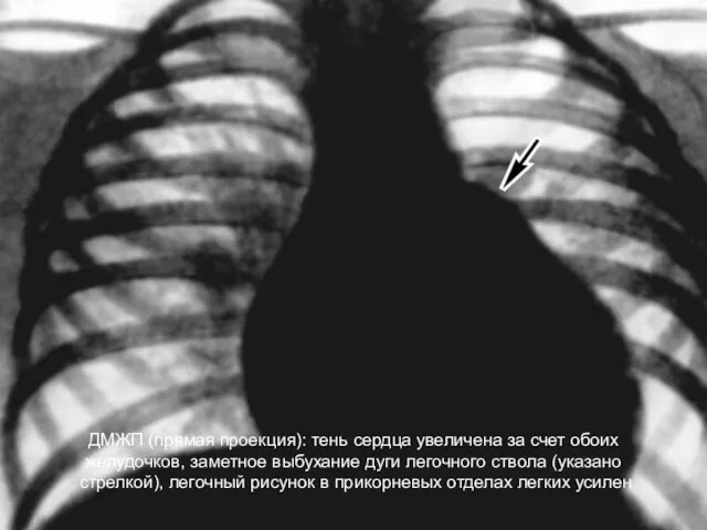 ДМЖП (прямая проекция): тень сердца увеличена за счет обоих желудочков, заметное выбухание дуги