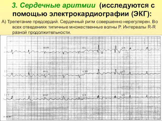 3. Сердечные аритмии (исследуются с помощью электрокардиографии (ЭКГ): А) Трепетание предсердий. Сердечный ритм