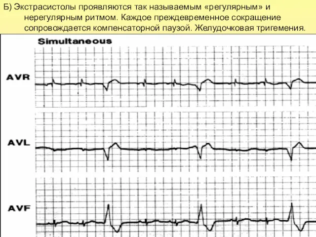 Б) Экстрасистолы проявляются так называемым «регулярным» и нерегулярным ритмом. Каждое преждевременное сокращение сопровождается