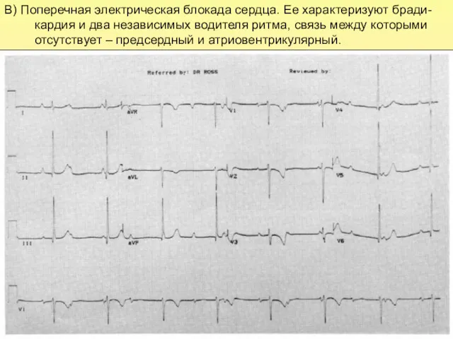 В) Поперечная электрическая блокада сердца. Ее характеризуют бради-кардия и два независимых водителя ритма,