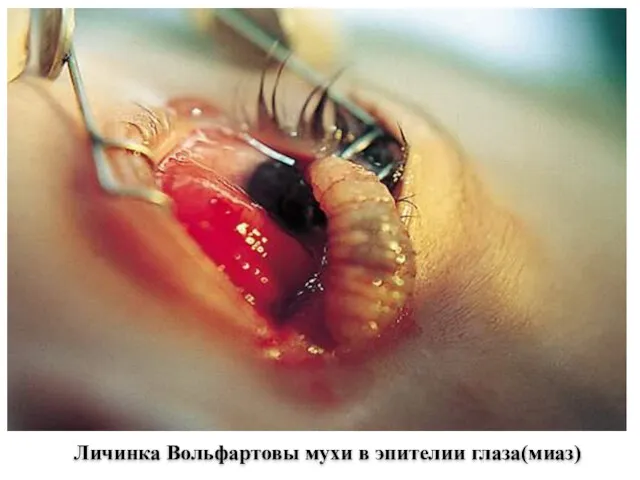 Личинка Вольфартовы мухи в эпителии глаза(миаз)