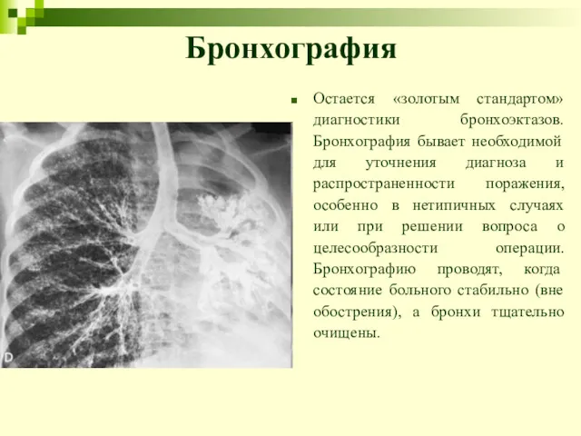 Бронхография Остается «золотым стандартом» диагностики бронхоэктазов. Бронхография бывает необходимой для