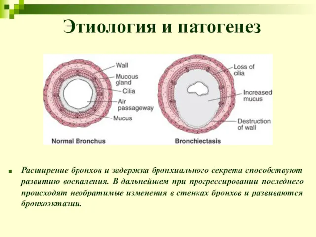 Этиология и патогенез Расширение бронхов и задержка бронхиального секрета способствуют