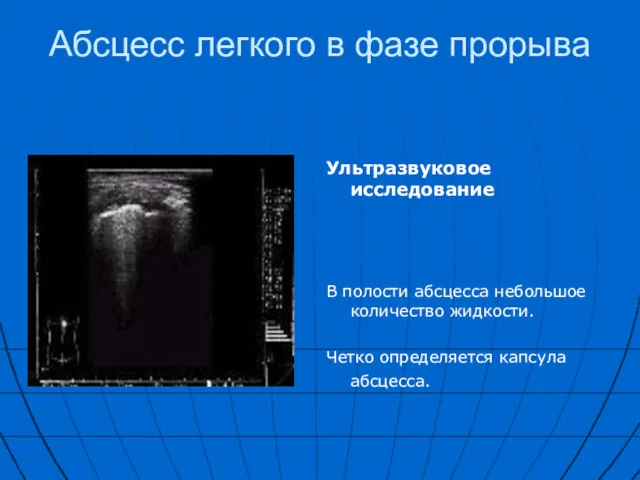 Абсцесс легкого в фазе прорыва Ультразвуковое исследование В полости абсцесса