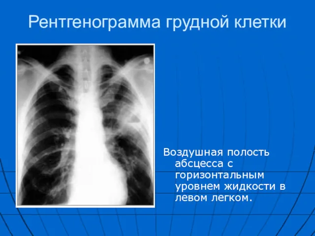 Рентгенограмма грудной клетки Воздушная полость абсцесса с горизонтальным уровнем жидкости в левом легком.