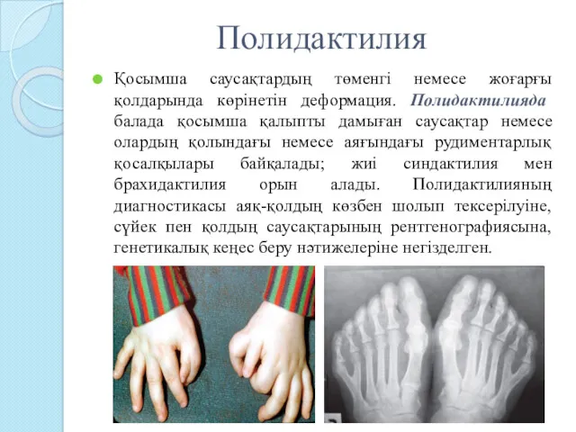 Полидактилия Қосымша саусақтардың төменгі немесе жоғарғы қолдарында көрінетін деформация. Полидактилияда