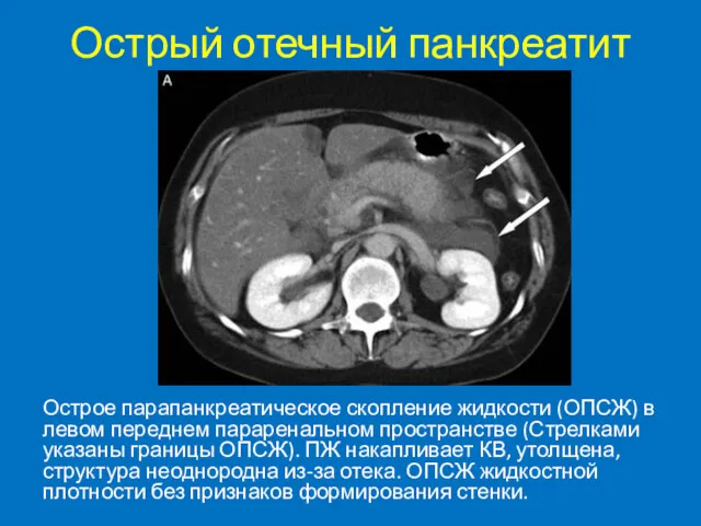 Острый отечный панкреатит Острое парапанкреатическое скопление жидкости (ОПСЖ) в левом переднем параренальном пространстве