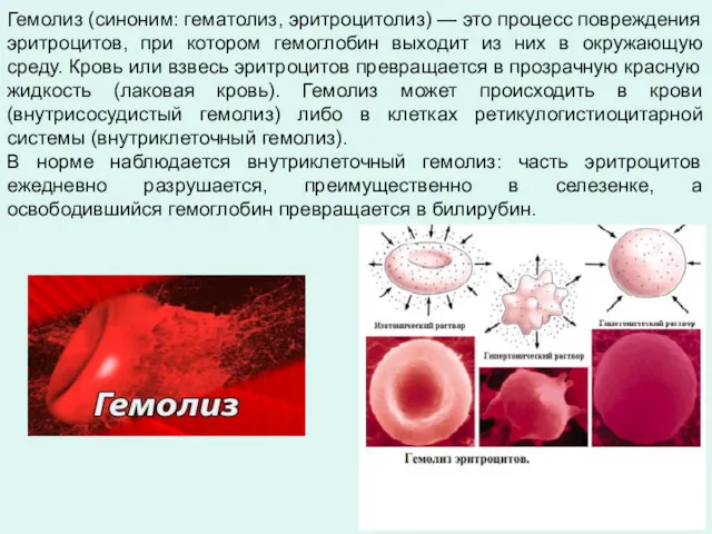 Гемолиз (синоним: гематолиз, эритроцитолиз) — это процесс повреждения эритроцитов, при