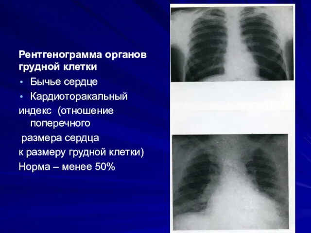 Рентгенограмма органов грудной клетки Бычье сердце Кардиоторакальный индекс (отношение поперечного