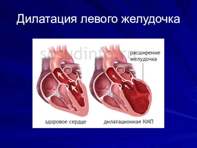 Дилатация левого желудочка