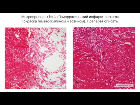 Микропрепарат № 3 «Геморрагический инфаркт легкого» (окраска гематоксилином и эозином). Препарат описать. Увеличение 40 Увеличение 100